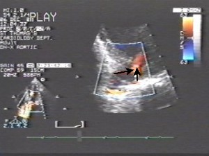 ao rjets4ch 1 300x225 Echocardiography