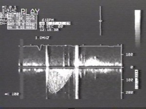 aor spectral env 300x225 Echocardiography