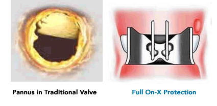 full-annulus full annulus Design Features
