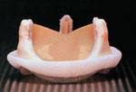 stented_tissue stented tissue Heart Valve Disease