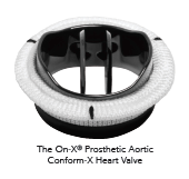 On-X Conform-X Heart Valve